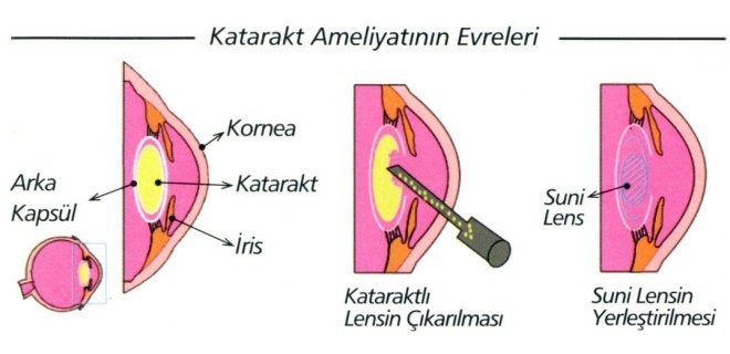 Fako Ameliyatı