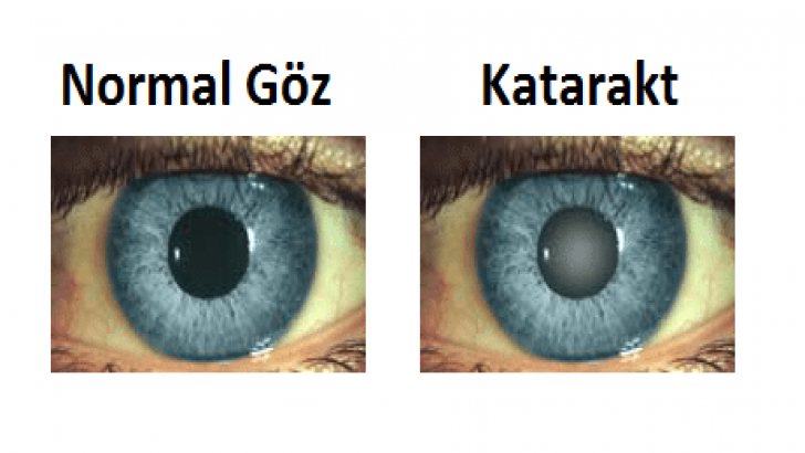 Katarak Görüşü