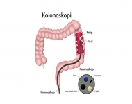 Kolonoskopi nedir, nasıl yapılır?