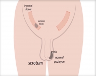 İnmemiş testis