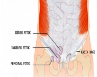 Kasık fıtığı (inguinal herni) tedavisi