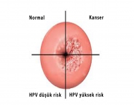 Koterizasyon nedir?