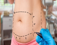 Dinamik ve estetik görünüm için: liposuction