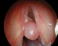 Ses kısıklığı ve laringoskopi ameliyatı