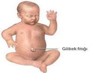 Göbek fıtığı (umblikal herni)