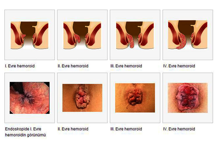 Hemoroid