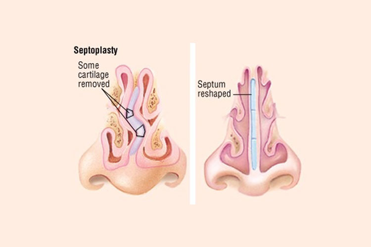 Septoplasti | septum deviasyonu tedavisi