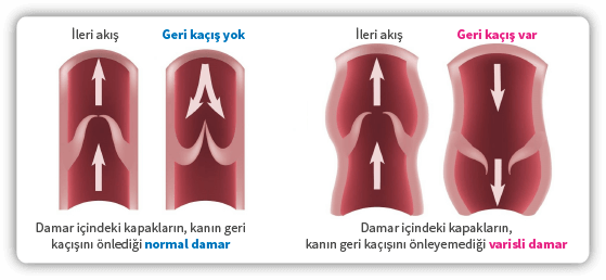 Lazerle varis tedavisi