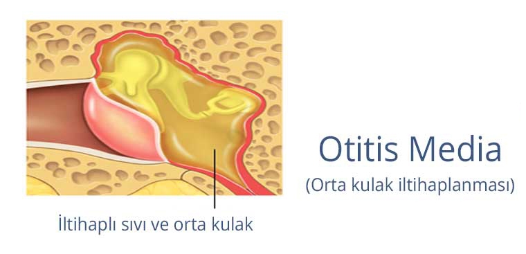 Orta kulak iltihabı