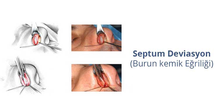 Septoplasti (burun deviasyonu)