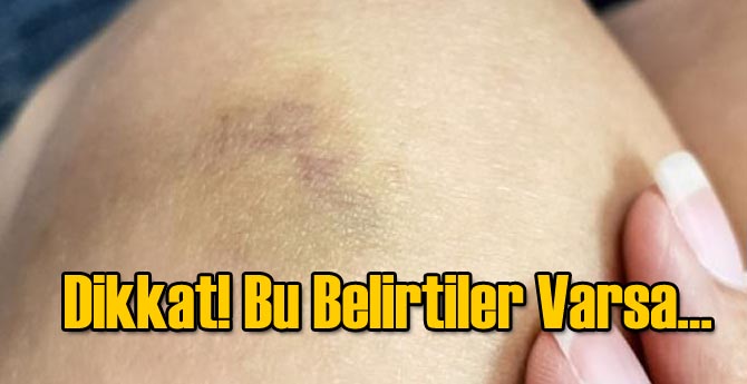 Bu belirtiler var ise karaciğer hastalığınız olabilir