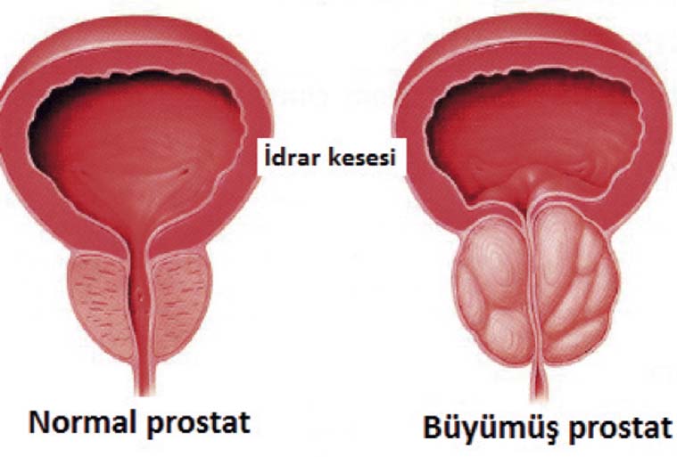 Lazerle prostat ameliyatı