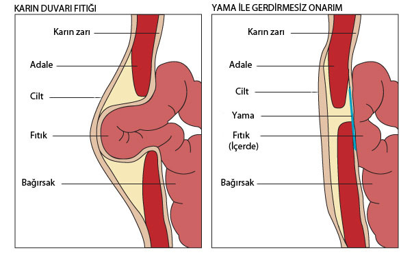 Yetişkinlerde göbek fıtığı