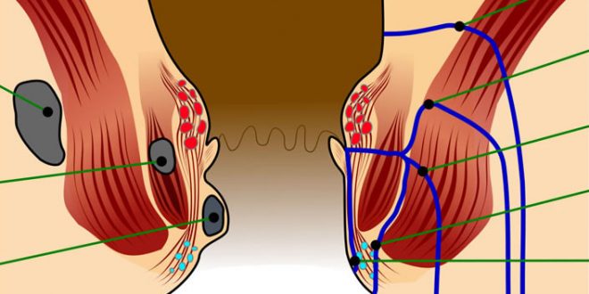 Hemorodoplasti nedir?