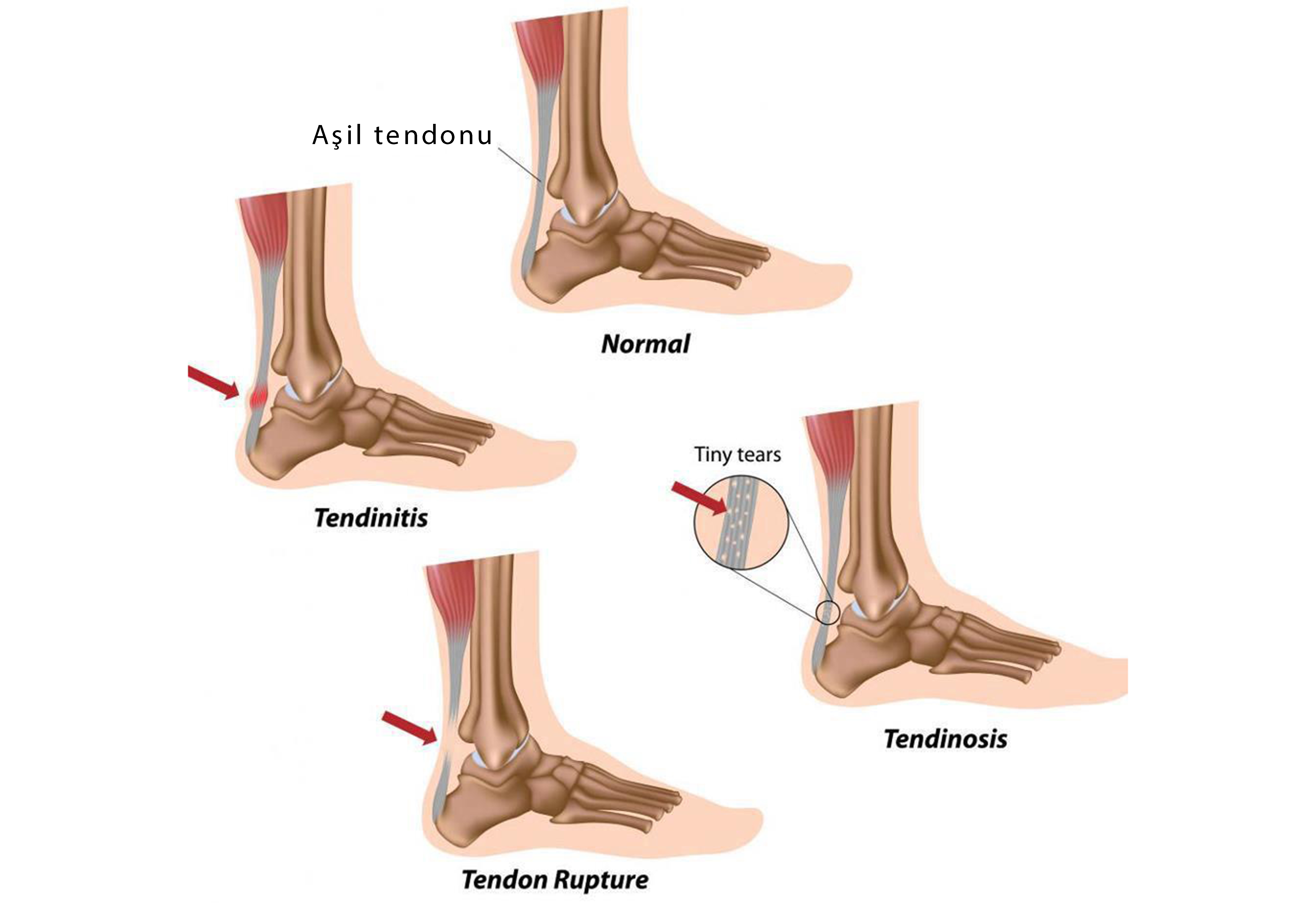 tendon iltihabi ozel meltem hastanesi