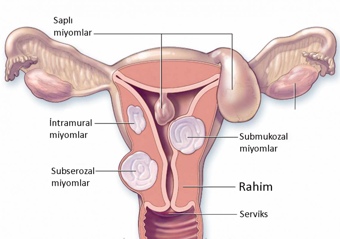 Myomektomi nedir? nasıl tedavi edilir?