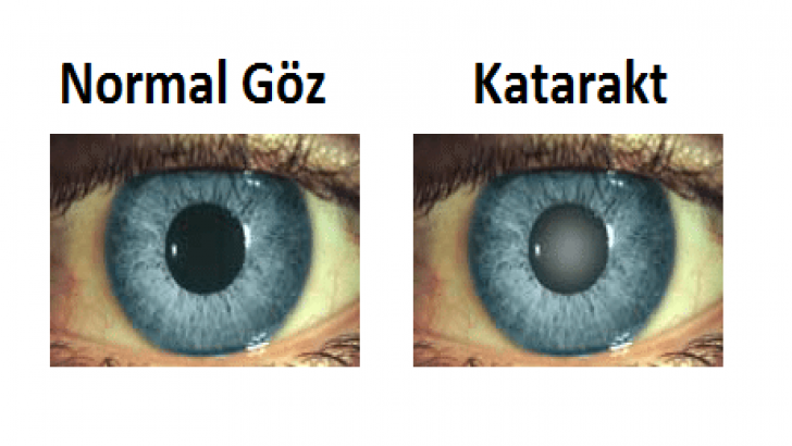 Katarakt nedir?