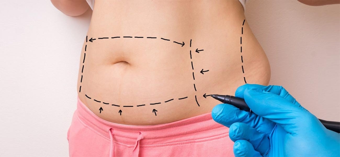 Karın germe karın estetiği abdominoplasti