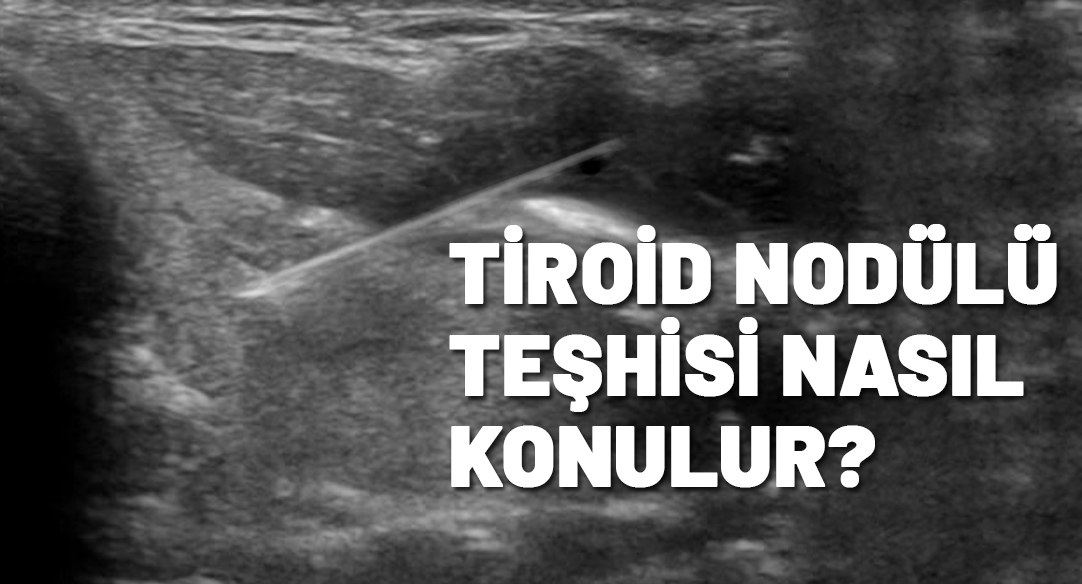 Tiroid nodülü teşhisi nasıl konulur?