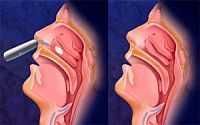 Konka hipertrofisi ve nasal polip (burunda et büyümesi)