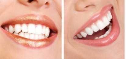 Diş implantları takıldıktan sonra nelere dikkat edilmeli