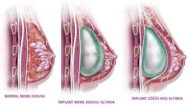 Göğüs büyültme ameliyatına dair tüm bilmek istedikleriniz