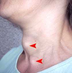 Tiroid - guatr ameliyatı sık sorulan sorular